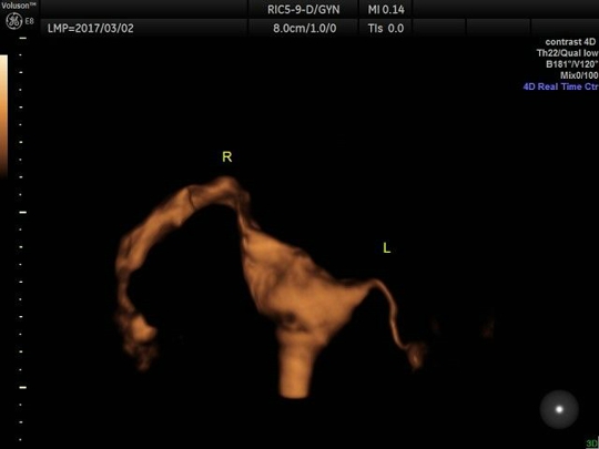 左侧输卵管通而不畅（全程纤细）